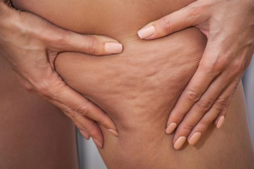 Fact or fiction: Cellulite is a build-up of toxins from a bad diet