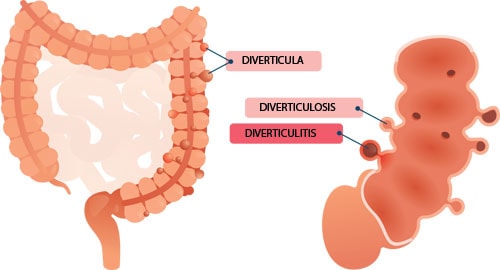 Large intestine labelled with diverticula, diverticulosis and diverticulitis